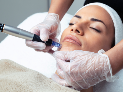 What does microneedling help with