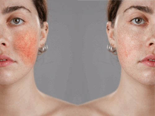 Does IPL Work for Rosacea? A Complete Treatment Guide