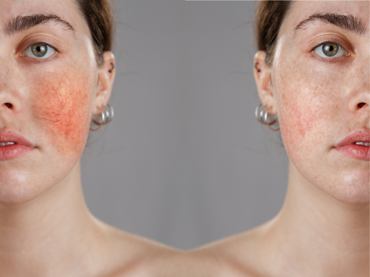 Does IPL Work for Rosacea? A Complete Treatment Guide